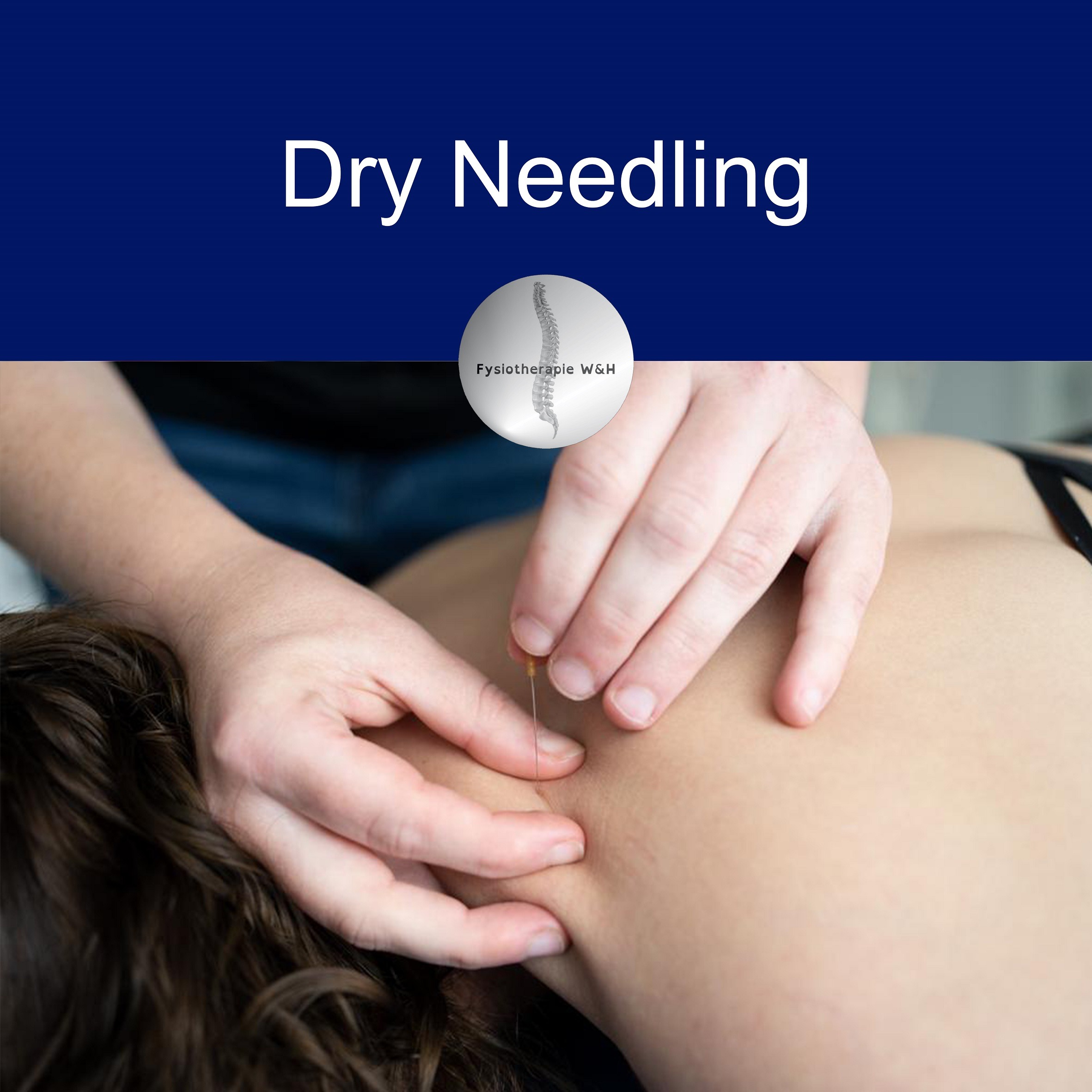 Dry Needling